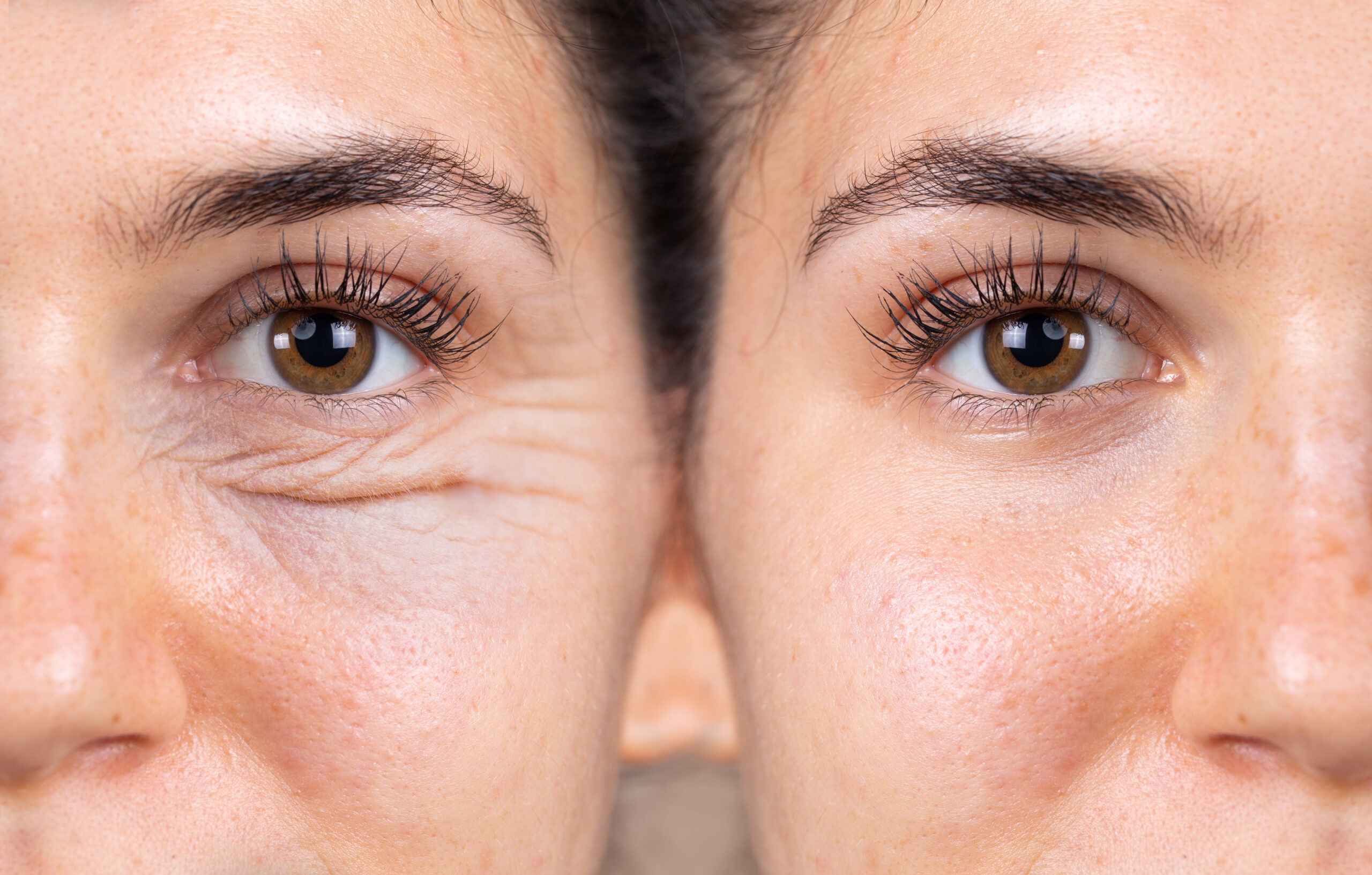 Eyelid Surgery 
